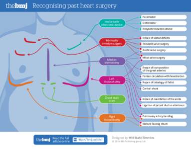 Recognising past heart surgery Pacemaker Implantable electronic device