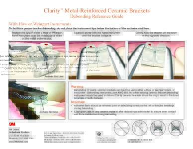 Clarity™ Metal-Reinforced Ceramic Brackets Debonding Reference Guide With How or Weingart Instruments To facilitate proper bracket debonding, do not place the instrument tips below the bottom of the archwire slot liner