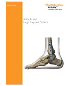 Surgical Technique  Ankle Fusion Large Fragment System  1