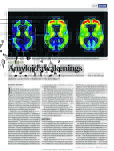 TAMMIE BENZINGER & TYLER BLAZEY, WASHINGTON UNIVERSITY  SLEEP OUTLOOK Patients with preclinical (centre) and clinical (right) Alzheimer’s disease show a marked increase in amyloid plaques (red and yellow) in the brain.