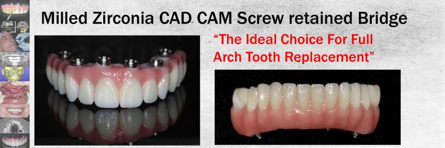 Milled Zirconia CAD CAM Screw retained Bridge “The Ideal Choice For Full Arch Tooth Replacement” Private Practice