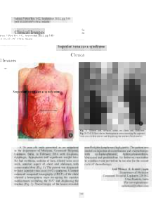 Indian J Med Res 142, September 2015, pp 350 DOI:Clinical Images Superior vena cava syndrome