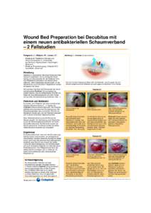 Wound Bed Preparation bei Decubitus mit einem neuen antibakteriellen Schaumverband – 2 Fallstudien Kvisgaard, J.1, Alsbjørn, B.1, Larsen, K.2, 1