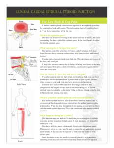 Lumbar CaudaL EpiduraL StEroid injECtion For Low Back & Leg Pain A lumbar caudal epidural corticosteroid injection is an outpatient procedure for treating low back and leg pain. This information sheet will explain what i