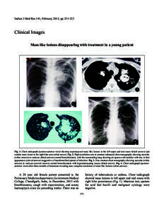 Indian J Med Res 141, February 2015, ppClinical Images Mass like lesions disappearing with treatment in a young patient  3