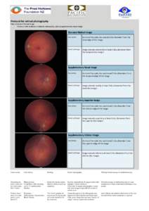 Protocol for retinal photography Take a Standard Retinal Image - If there is ANY evidence of diabetic retinopathy, take a Supplementary Nasal Image Standard Retinal Image Description