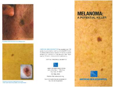 MELANOMA MELANOMA FACTS FACTS About About 76,100