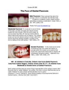 Caclinch © 2008  The Face of Dental Fluorosis Mild Fluorosis “Dean advised that when the average child in a community has mild fluorosis, 