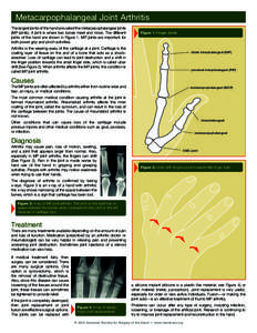 Metacarpophalangeal Joint Arthritis The largest joints of the hand are called the metacarpophalangeal joints (MP joints). A joint is where two bones meet and move. The different joints of the hand are shown in Figure 1. 