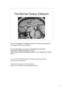 The Normal Corpus Callosum  BODY SPLENIUM GENU