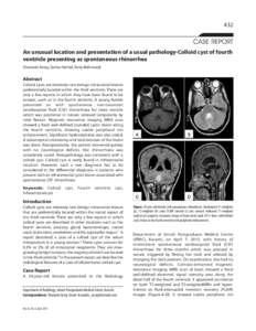 432  CASE REPORT An unusual location and presentation of a usual pathology-Colloid cyst of fourth ventricle presenting as spontaneous rhinorrhea Shumaila Arooj, Samar Hamid, Tariq Mehmood