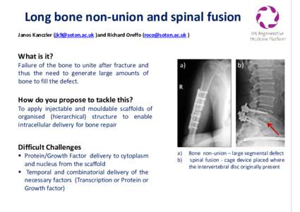 Long bone non-union and spinal fusion Janos Kanczler ( )and Richard Oreffo ( ) What is it?  Failure of the bone to unite after fracture and