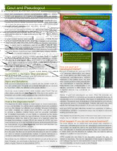 Gout and Pseudogout Gout and pseudogout—calcium pyrophosphate deposition disease (CPPD)—are two types of crystalline arthropathies which are disease processes that cause sore joints because salt crystals have formed 