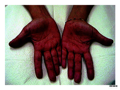 CS112378  Palmar rash Source: Dr. John Toney, Southeast STD/HIV Prevention Training Center