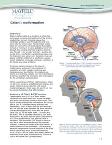 Chiari I malformation  Overview Chiari I malformation is a condition in which the bony space enclosing the lower part of the brain is