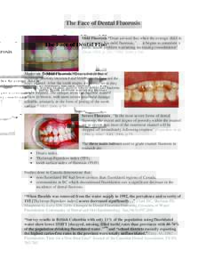 The Face of Dental Fluorosis Mild Fluorosis “Dean advised that when the average child in a community has mild fluorosis, 