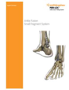 Surgical Technique  Ankle Fusion Small Fragment System  1