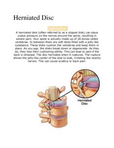 Herniated Disc Definition A herniated disk (often referred to as a slipped disk) can place undue pressure on the nerves around the spine, resulting in severe pain. Your spine is actually made up of 26 bones called