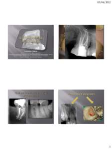 Tooth development / Dentistry / Dentin / Pulp capping / Pulp / Odontoblast / AJ