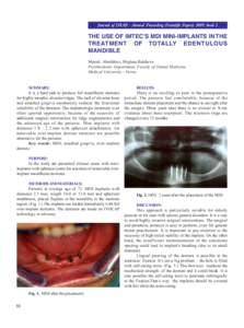 Journal of IMAB - Annual Proceeding (Scientific Papers) 2009, book 2  THE USE OF IMTEC’S MDI MINI-IMPLANTS IN THE TREATMENT OF TOTALLY EDENTULOUS MANDIBLE Metodi Abadzhiev, Miglena Balcheva